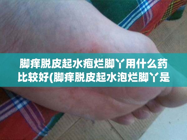 脚痒脱皮起水疱烂脚丫用什么药比较好(脚痒脱皮起水泡烂脚丫是什么原因)